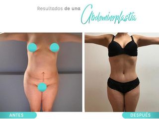 Antes y después de Abdominoplastia