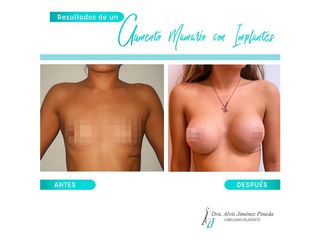 Antes y después de Aumento de busto