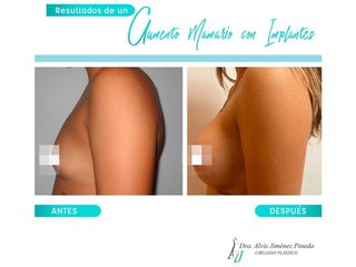 Antes y después de Aumento de busto