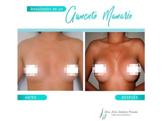 Antes y después de Aumento mamario