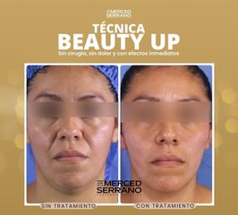 Rejuvenecimiento Facial - Dr. Merced Serrano