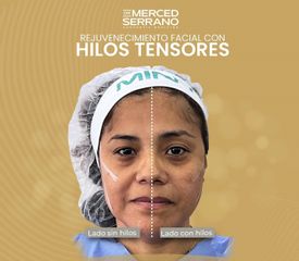Hilos tensores - Dr. Merced Serrano