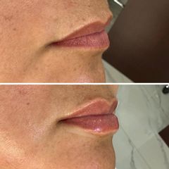 Aumento de labios - Dr. Merced Serrano