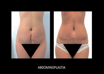 Antes y después de  Abdominoplastía, vista frontal.