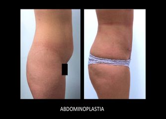 Antes y después de Abdominoplastía. vista lateral