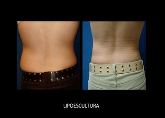 Antes y después de Lipoescultura