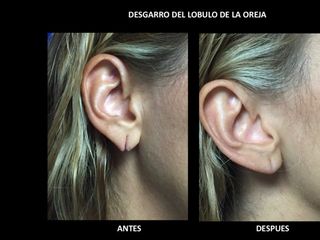 Antes y después de Cirugía reconstructiva de lóbulo 