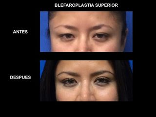 Antes y después de Blefaroplastía superior