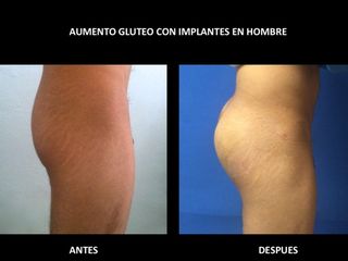 Antes y después de Implantes glúteos en hombre