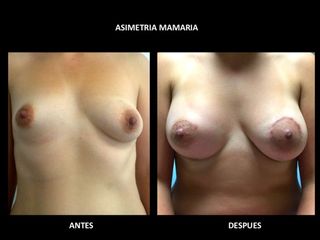 Antes y después de un aumento mamario con corrección de asimetría