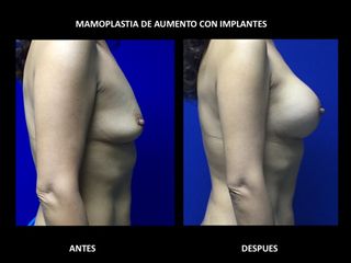 Antes y después de Mamoplastia