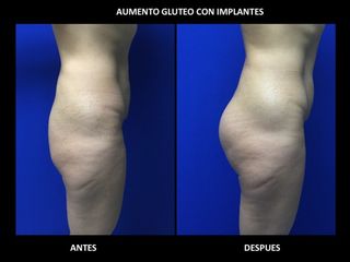 Antes y después de  Implantes glúteos