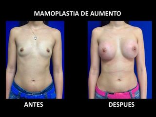 Antes y después de Mamoplastia de Aumento