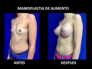 Antes y después de Mamoplastia de Aumento
