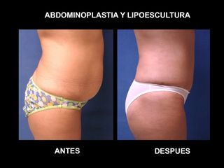 Antes y después de abdominoplastia y lipoescultura