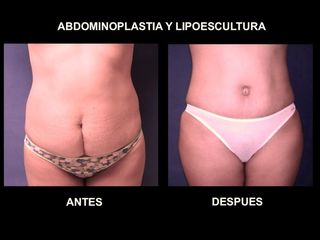 Antes y después de abdominoplastia y lipoescultura