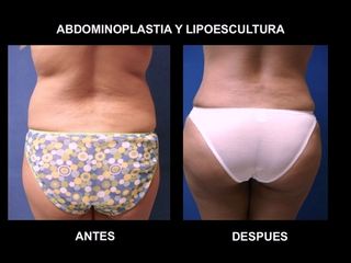 Antes y después de Abdominoplastia y Lipoescultura