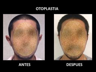 Antes y después de Otoplastia