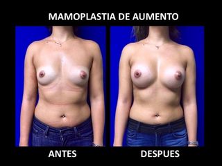 Antes y después de Mamoplastia de Aumento