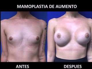 Antes y después de Mamoplastia de Aumento