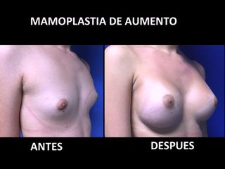 Antes y después de Mamoplastia de Aumento