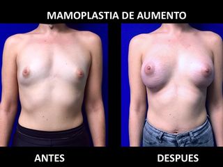 Antes y después de Mamoplastia de Aumento