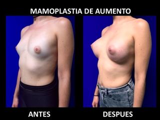 Antes y después de Mamoplastia de Aumento