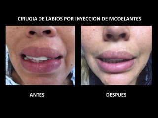 Antes y después de Aumento de Labios