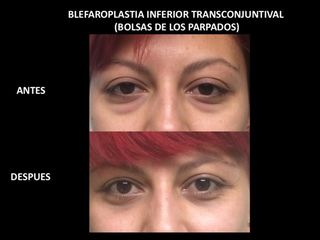 Antes y después de Blefaropalstia inferior transconjuntival