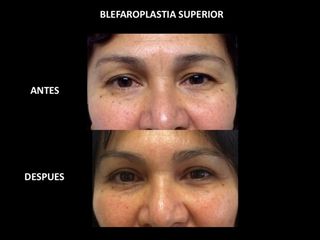 Antes y después de Blefaroplastia superior