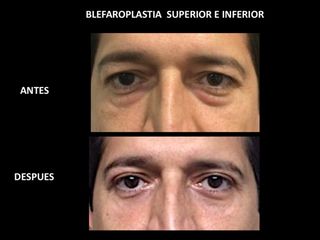 Antes y después de Blefaroplastia en hombre