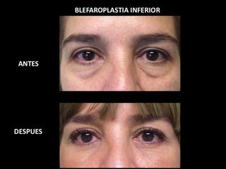 Antes y después de Blefaroplastia inferior