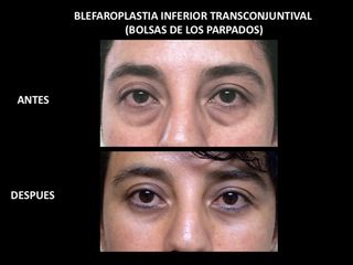 Antes y después de Blefaroplastia inferior trasnconjuntival