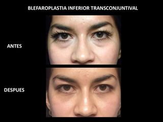 Antes y después de Blefaropalstia inferior transconjuntival