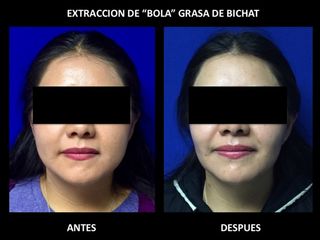 Antes y después de Bolsas Bichat