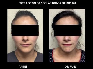 Antes y después de Bolsas Bichat