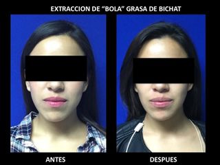 Antes y después de Bolsas Bichat