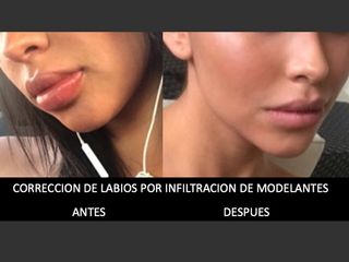 Antes y después de Reducción de labios