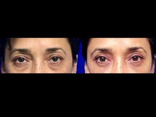 Antes y después de Blefaroplastía inferior Transconjuntival
