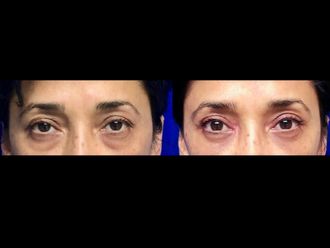 Blefaroplastia - 634564