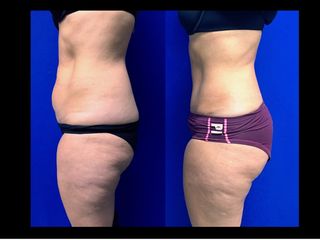Antes y después de Abdominoplastía. Vista Lateral