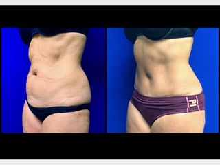 Antes y después de Abdominoplastía vista 3/4 de perfil