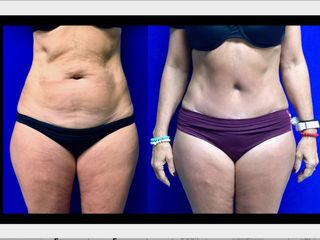 Antes y después de Abdominoplastía vista frontal