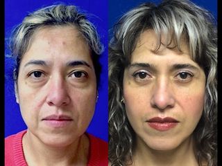 Antes y después de Blefaroplastía superior e inferior