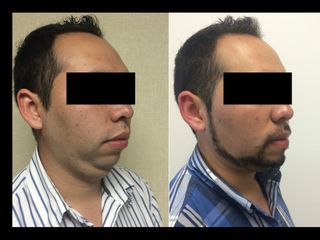 Antes y después de Mentoplastia
