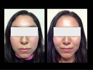 Antes y después de Mentoplastia