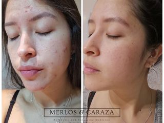 Tratamiento para acne