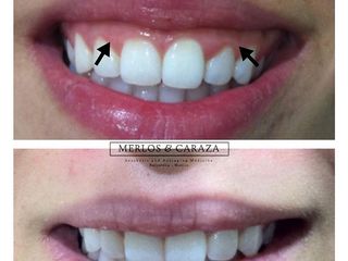 Corrección de sonrisa gingival 