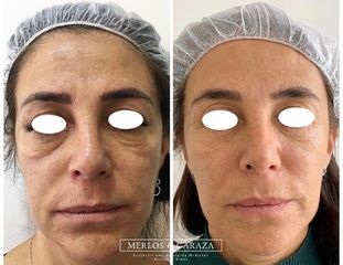 Rejuvenecimiento facial integral