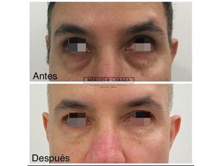 Blefaroplastia